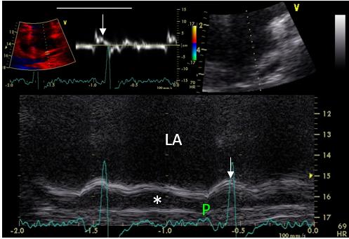 Figure 47. M-mode and tissue Doppler of the superior LA wall. Atrial systolic contraction