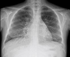 Chest Xray antero-posterior view signs of congestion
