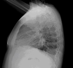 Chest Xray lateral view signs of congestion