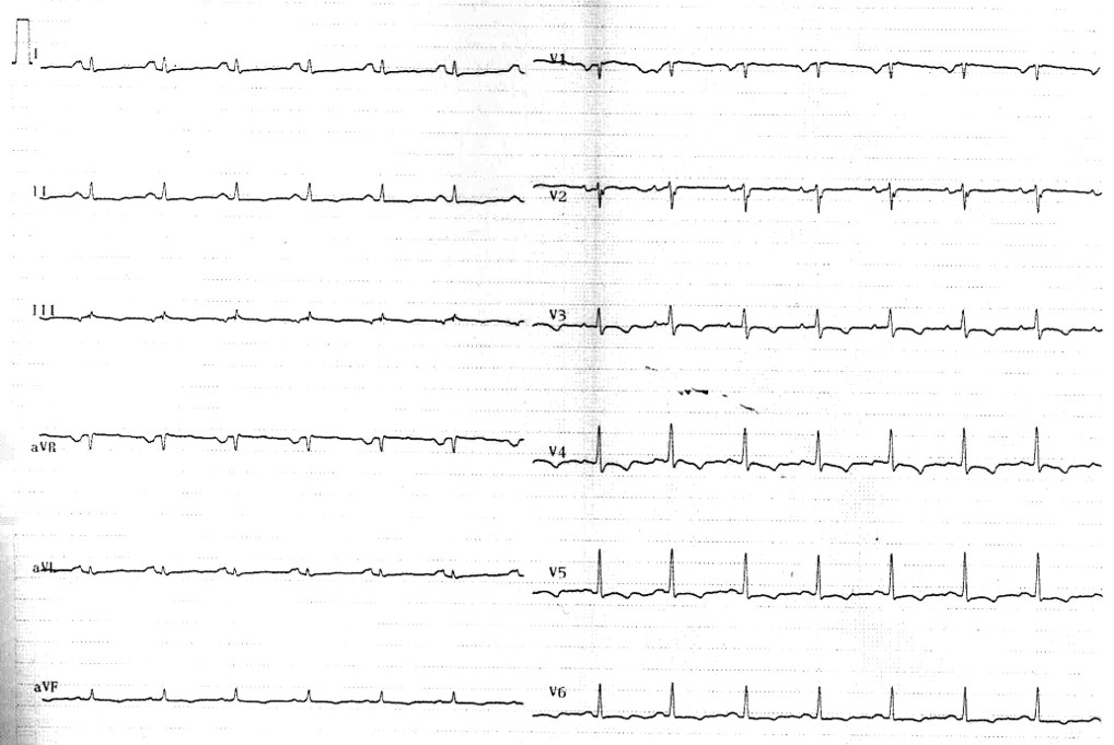 12 lead ECG with diffuse T wave inversion