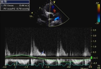 Continuous wave Doppler of pulmonary regurgitation