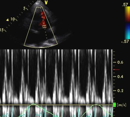 Transthoracic pulsed Doppler apical 4-chamber mitral valve flow
