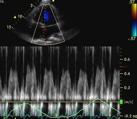Transthoracic pulsed Doppler apical 4-chamber pulmonary venous flow