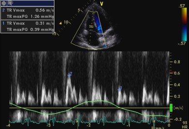 Apical 4-chamber pulsed Doppler transtricuspid flow