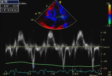Tissue Doppler velocities, lateral mitral annulus
