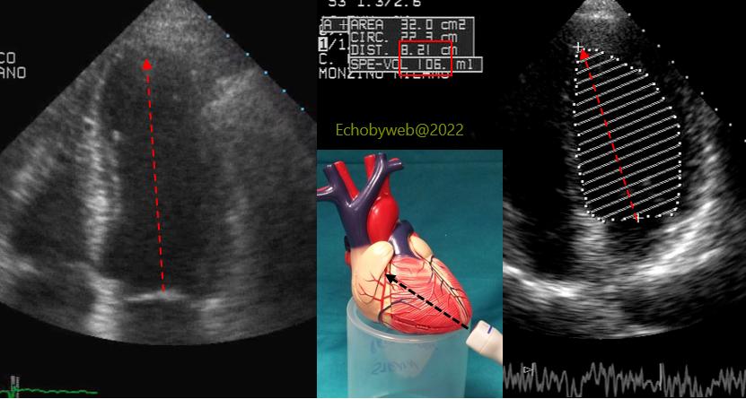Example of correct positioning of the transducer on the true left ventricular apex