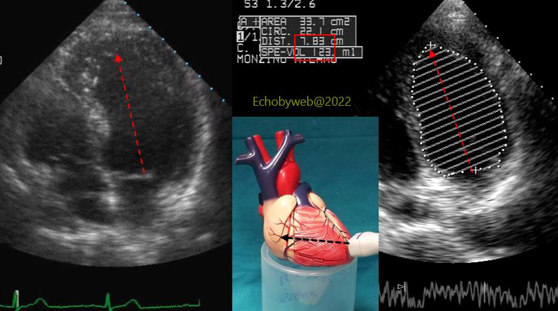 Example of left ventricular long axis foreshortening