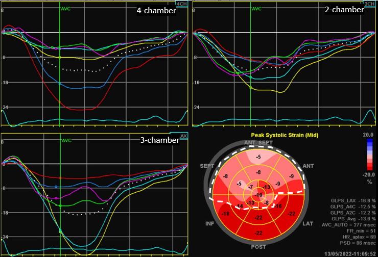 Figure 11. Automated Function Imaging analysis of global and segmental longitudinal LV strain