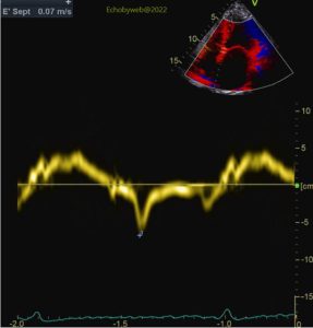 Figure 5. Tissue Doppler, apical 4-chambers, medial mitral annulus