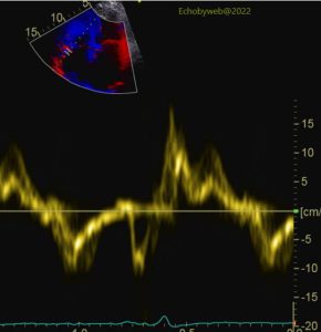 Figure 14. Tissue Doppler, apical 4-chambers, tricuspid annulus