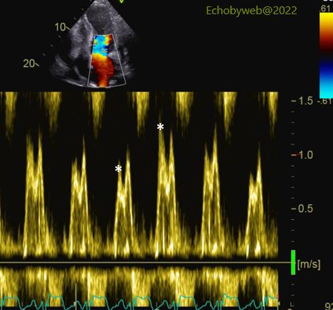 Figure 7. Pulsed Doppler apical 4-chamber view, mitral valve flow