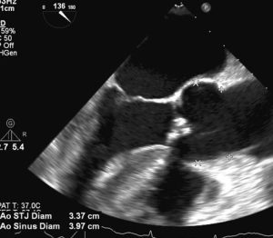 Figure 5. 2D upper esophagus long axis aorta