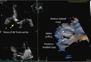 Figure 10. 3D aortic valve, view from aorta (dashed yellow arrow)