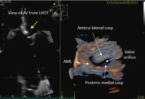 Figure 12. 3D aortic valve, view from LV (dashed yellow arrow)