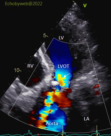 Figure 7. Color Doppler apical 5-chambers, aortic valve
