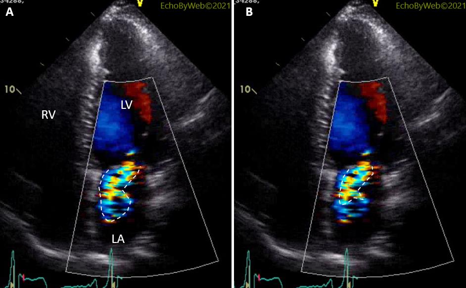 Figure 8. Color Doppler apical 4-chamber view with planimetry of the area of regurgitation