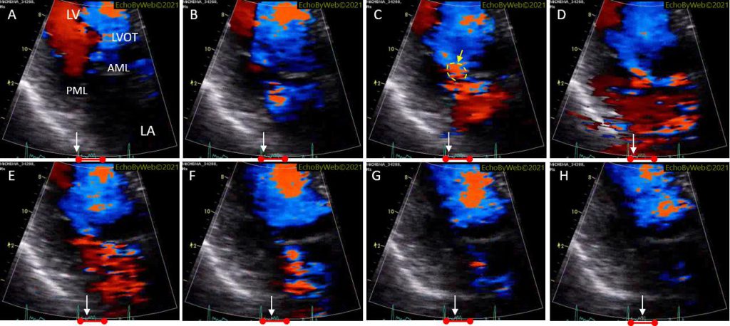 Figure 14.  Color Doppler parasternal long axis, mitral valve, frame-by-frame analysis