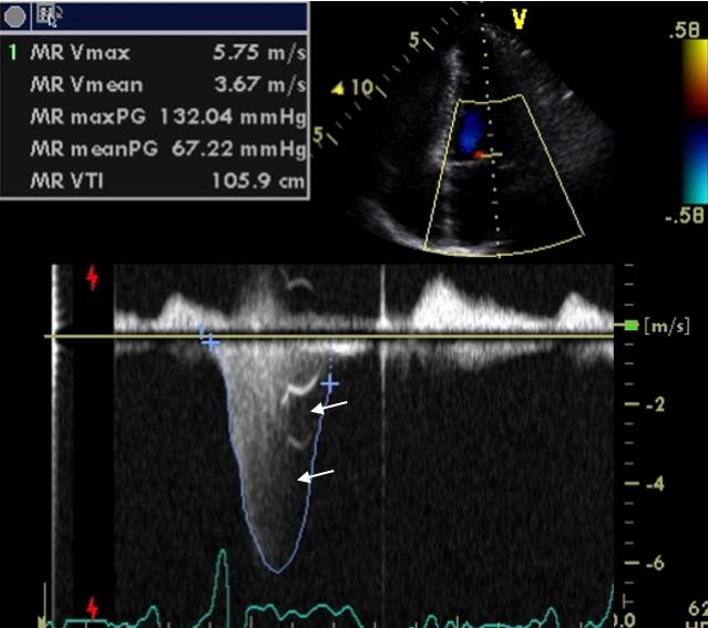 Figure 12. Continuous wave Doppler apical 4-chambers, mitral valve