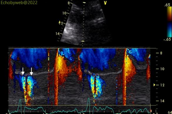 Figure 10. Color Doppler M-mode, apical 4-chambers, mitral valve
