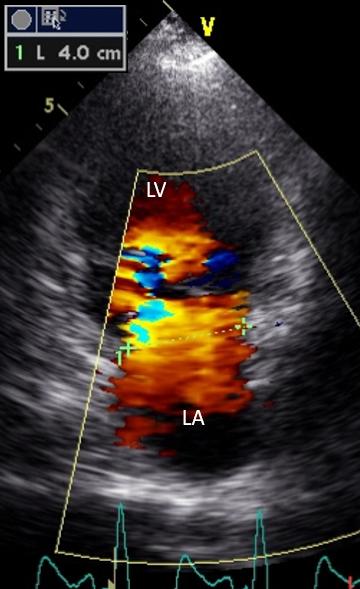 Figure 19. Color Doppler apical 2-chambers, mitral annulus