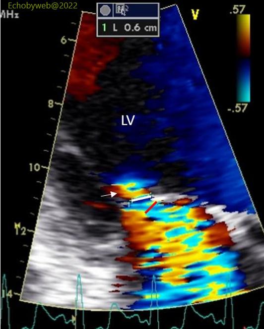 Figure 10. Color Doppler apical 3-chambers