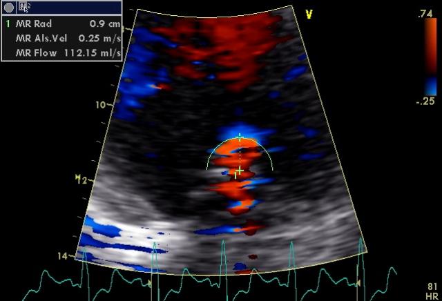 Figure 13. Color Doppler apical 4-chambers