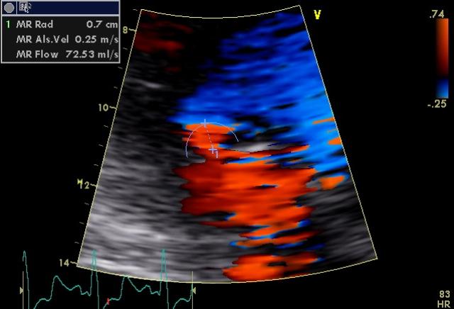Figure 12. Color Doppler apical 3-chambers