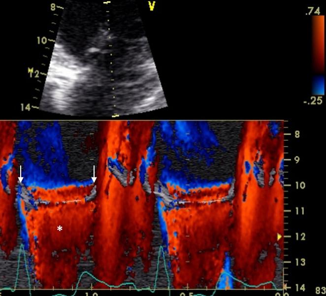 Figure 11. Color M-mode apical 4-chambers, mitral flow