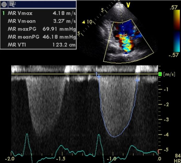 Figure 14. Continuous-wave Doppler Apical 3-chambers, mitral valve