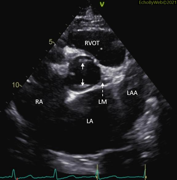 Figure 3. 2D parasternal short axis, aortic valve