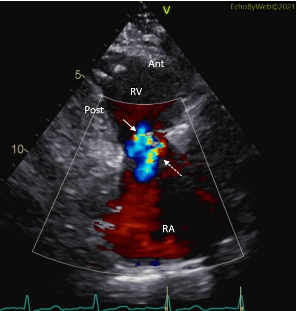 Figure 12. Color Doppler parasternal long axis, tricuspid annulus