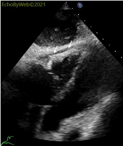 Figure 9. 2D subcostal 4-chamber view. Pericardial adhesions