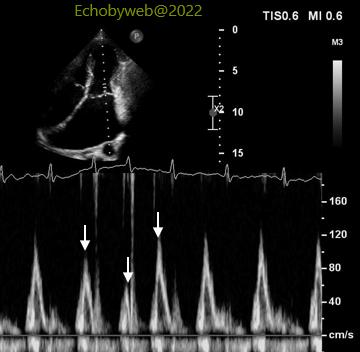 Figure 12. Pulsed Doppler apical 4-chamber. mitral valve flow profile