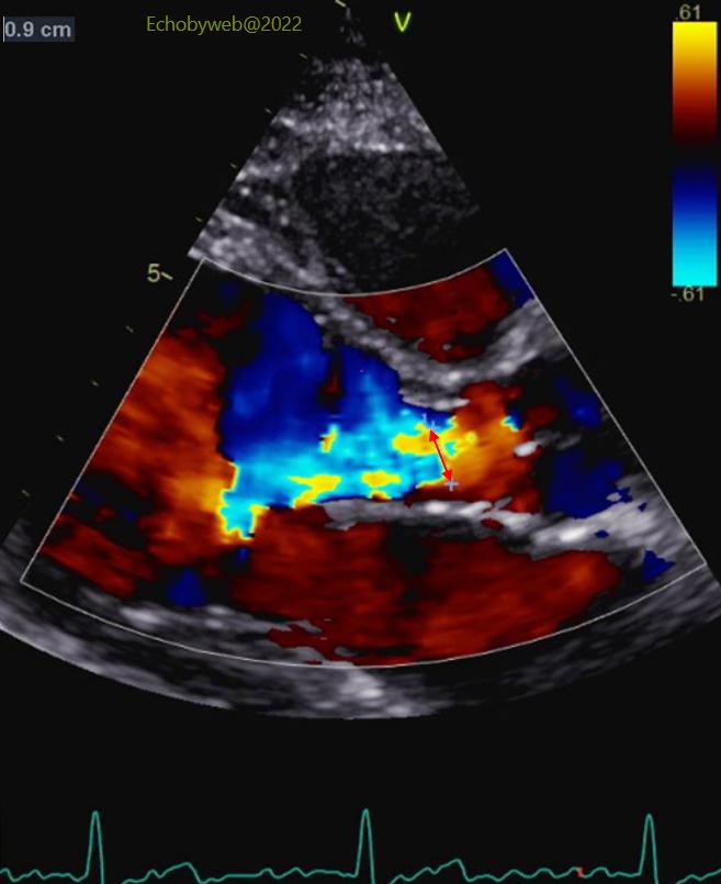 Figure 15. TT color Doppler, parasternal long axis, jet width of aortic regurgitation
