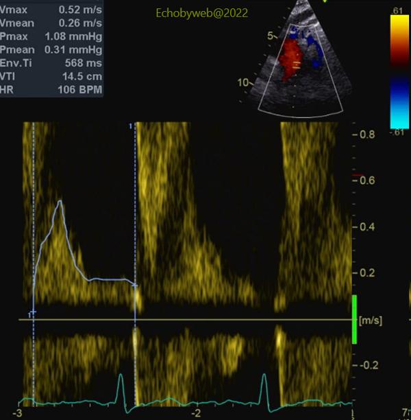Figure 17. TT pulsed Doppler, giugular view, aortic backflow