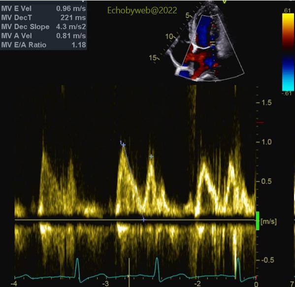 Figure 4. Pulsed Doppler apical 4-chamber, mitral flow profile