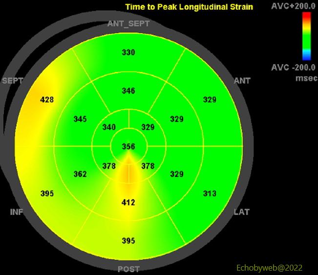 Figure 14. Longitudinal strain, time to peak strain
