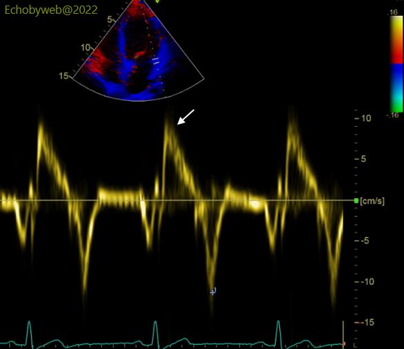 Figure 10. Pulsed tissue Doppler, apical 4-chamber, lateral mitral annulus