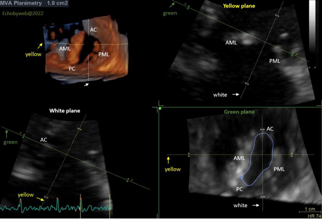 Figure 10. 3D exam, GE FlexiSlice modality, measurement of mitral valve area