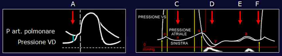 Figura 03a -Le diverse pressioni di riempimento VS