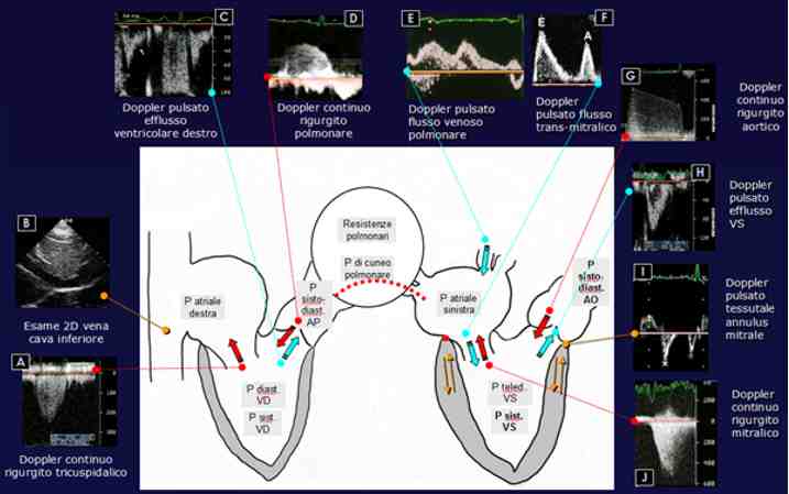 Figura 03c - Emodinamica non invasiva ecocardiografica