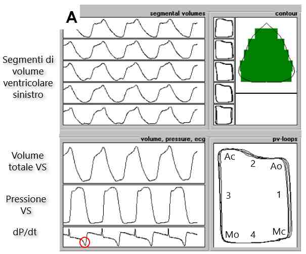 Figura 04a - Componenti del loop pressione-volume VS