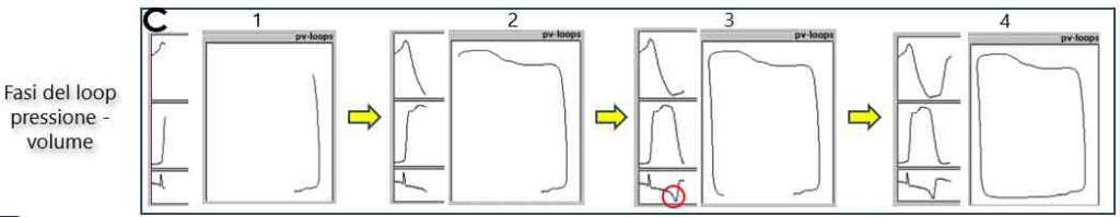 Figura 04c - Costruzione del loop pressione-volume VS
