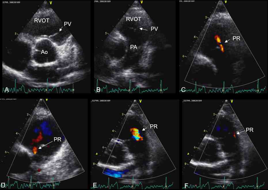 Figura 09 - Individuazione con color Doppler del rigurgito fisiologico valvolare polmonare nella proiezione parasternale assse corto della base