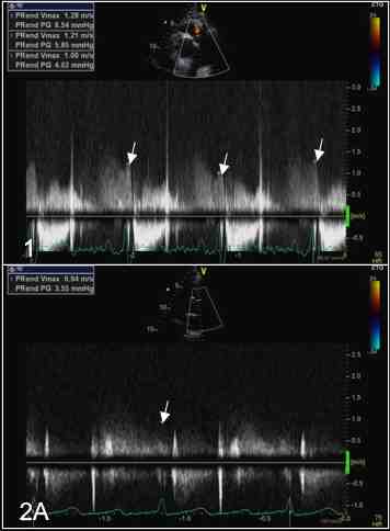 Figura 15-1: Doppler continuo del rigurgito polmonare: variabilità respiratoria della velocità telediastolica (frecce)

Figura 15-2A: Doppler continuo del rigurgito polmonare: scarsa qualità della velocità telediastolica (freccia)