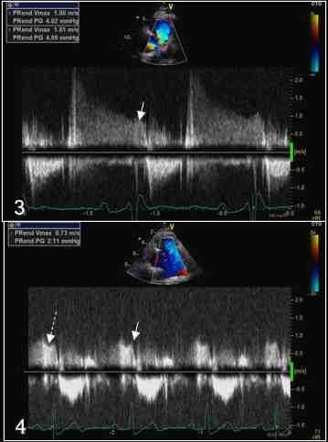 Figura 15-3: Doppler continuo del rigurgito polmonare,

Figura 15-4: Doppler continuo del rigurgito polmonare: profilo incompleto ma con sufficiente vsualizzazione della velocità in telediastole