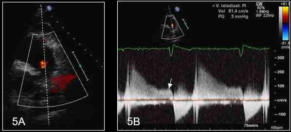 Figura 15-5A - Color Doppler delll' efflusso VD e valvola polmonare con allineamento del cursore Doppler continuo con il fisiologico rigurgito polmonare

Figura 15-5B - Doppler continuo rigurgito polmonare: assente incisura telediastolica per presenza di fribrillazione atriale