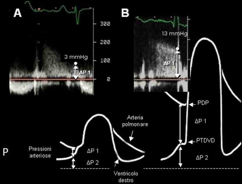 Figura 11a - Calcolo della pressione diastolica polmonare