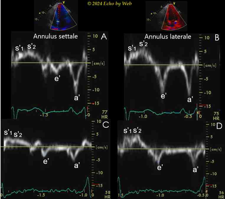 Figura 14 - Esempi di stima del rilasciamento VS utilizzando il Doppler tessutale dell'annulus mitralico