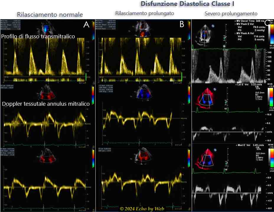 Figura 15 - Esempi di stima del rilasciamento VS utilizzando il Doppler pulsato del flusso transmitralico ed il Doppler tessutale dell'annulus mitralico